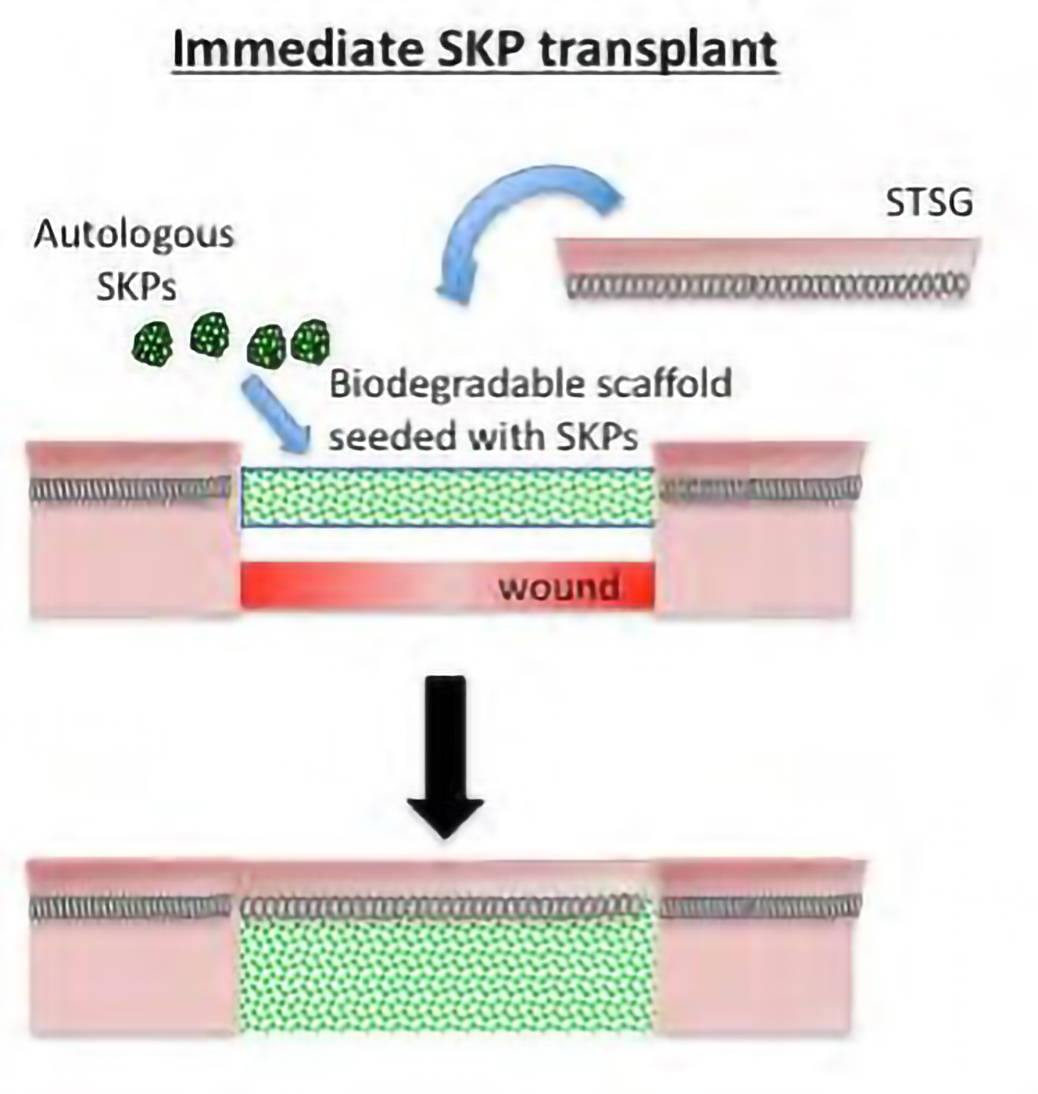 skp transplant 2