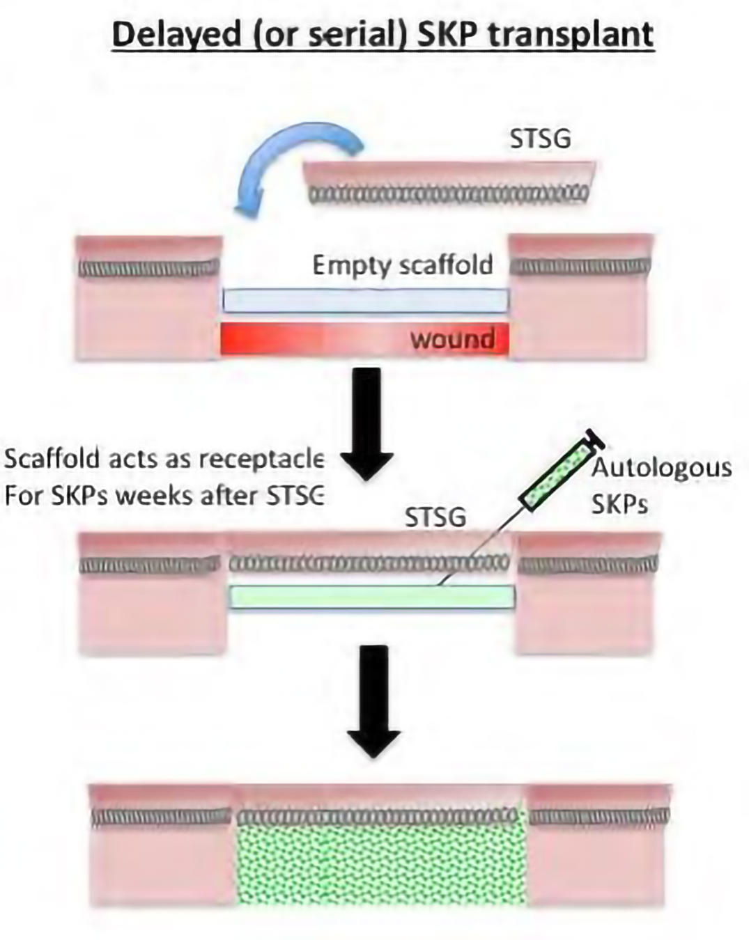 skp transplant