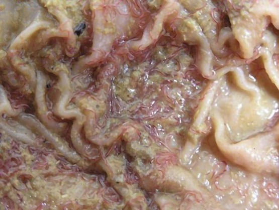 intestinal worms in stool