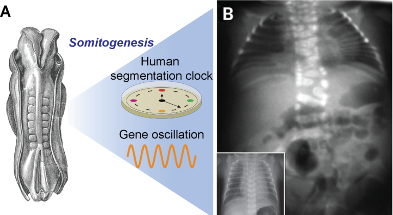 A. An illustration of a Carnegie stage 10 human embryo (adapted from Grey H., 1918). B. An X-Ray radiograph of an affected individual with SCDO4 (adapted from Sparrow D. et al., 2008). Insert shows the normal morphology of the spine and rib. A. An illustration of a Carnegie stage 10 human embryo (adapted from Grey H., 1918). B. An X-Ray radiograph of an affected individual with SCDO4 (adapted from Sparrow D. et al., 2008). Insert shows the normal morphology of the spine and rib.