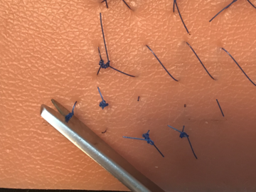 Cut out your suture