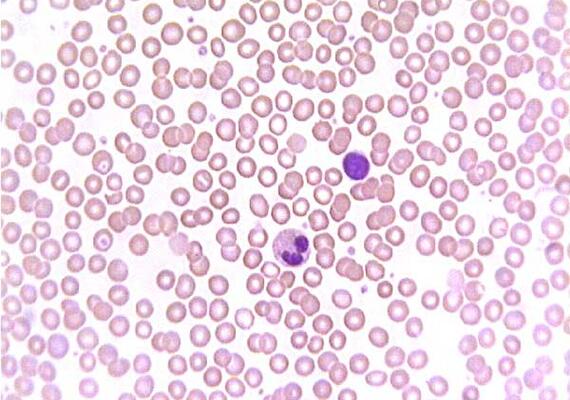 Blood Smear- Image Credit to siumed.edu