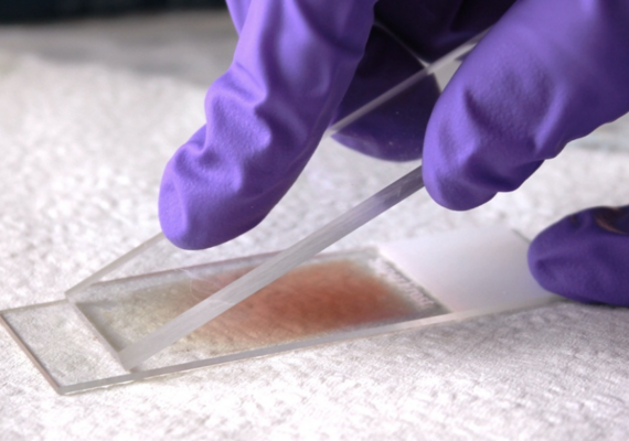 Blood Smear