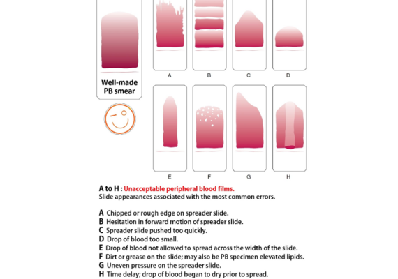Blood Smear Technique
