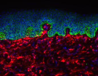 Skin immunohistochemistry; red - fibroblasts, green - keratin 5, blue - nuclei